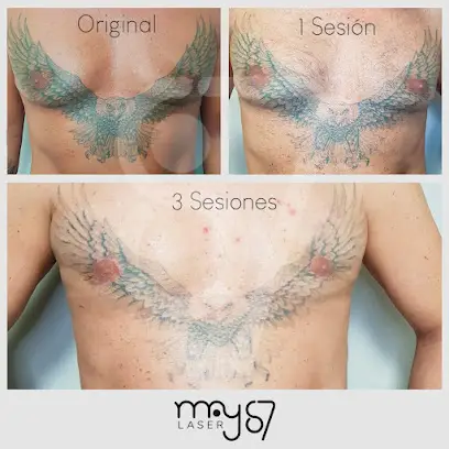 Maylaser87 - Eliminación de Tatuajes